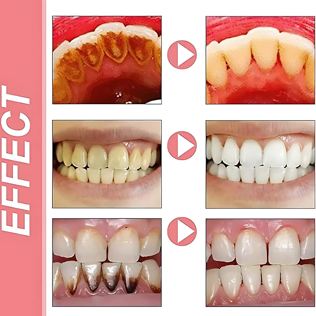 ProbioticToothpaste 1+1 GRATIS: Mild Hvitgjøring Styrkende Probiotisk Tannkrem