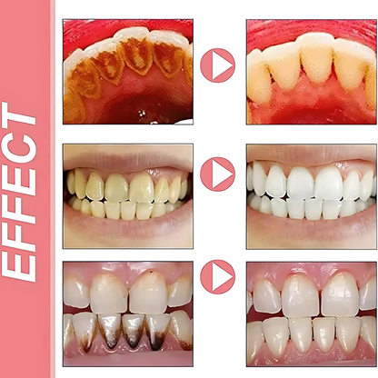 ProbioticToothpaste 1+1 GRATIS: Mild Hvitgjøring Styrkende Probiotisk Tannkrem