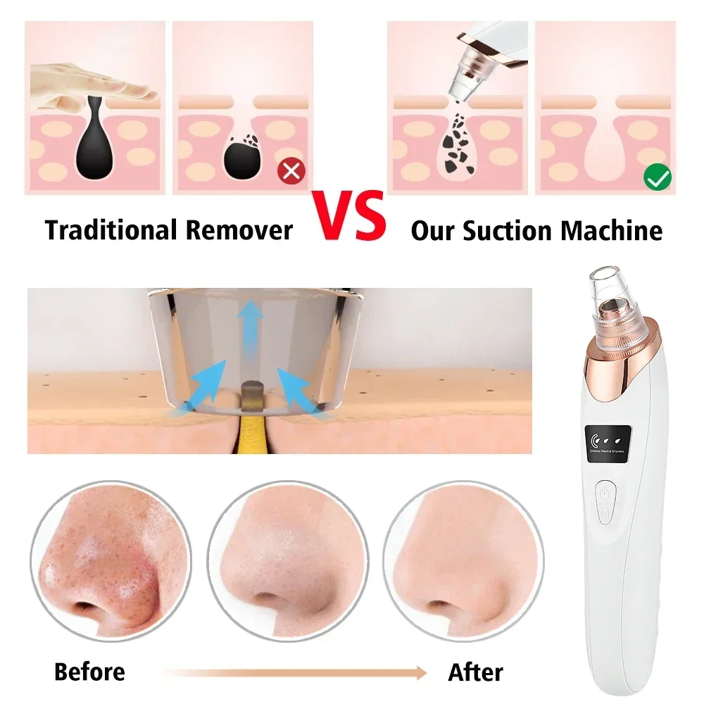 PoreRemover: Oppladbart Smart Kit for Fjerning av Hudormer, Hvite Hudormer og Porer