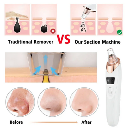 PoreRemover: Oppladbart Smart Kit for Fjerning av Hudormer, Hvite Hudormer og Porer