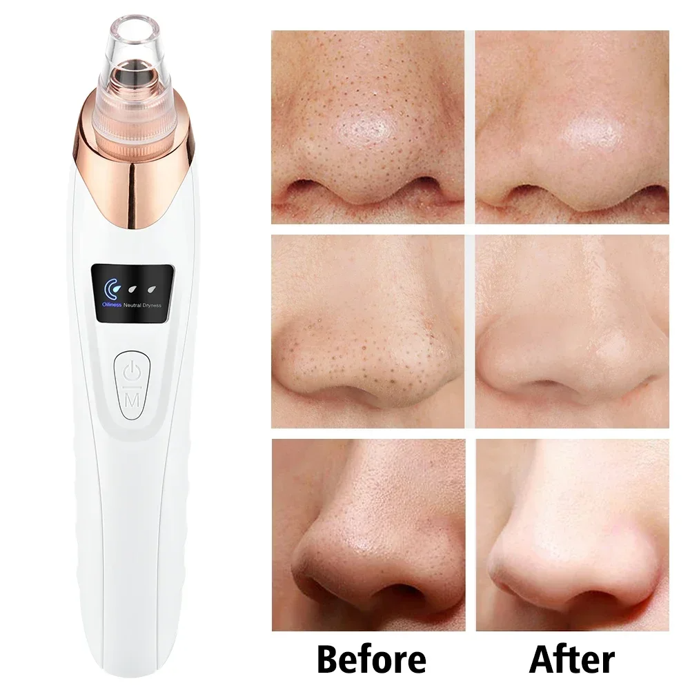 PoreRemover: Oppladbart Smart Kit for Fjerning av Hudormer, Hvite Hudormer og Porer