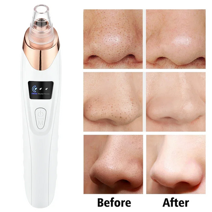 PoreRemover: Oppladbart Smart Kit for Fjerning av Hudormer, Hvite Hudormer og Porer