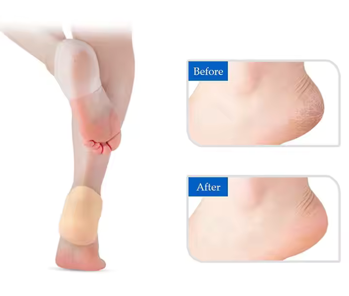 Happy™ HeelProtector 1+1 GRATIS - Myk Silikon Hælbeskytter